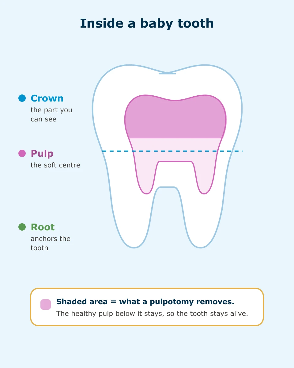 Diagram of a baby tooth showing the crown, the pulp at its centre, and the root, with the portion a pulpotomy removes shaded